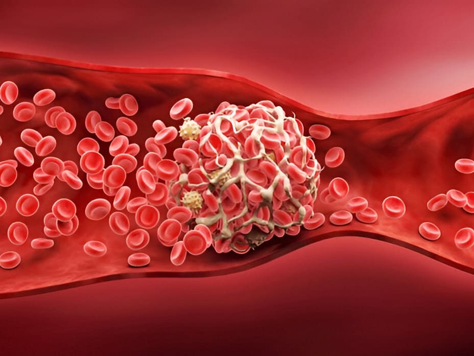 Tratamiento de la insuficiencia arterial aguda